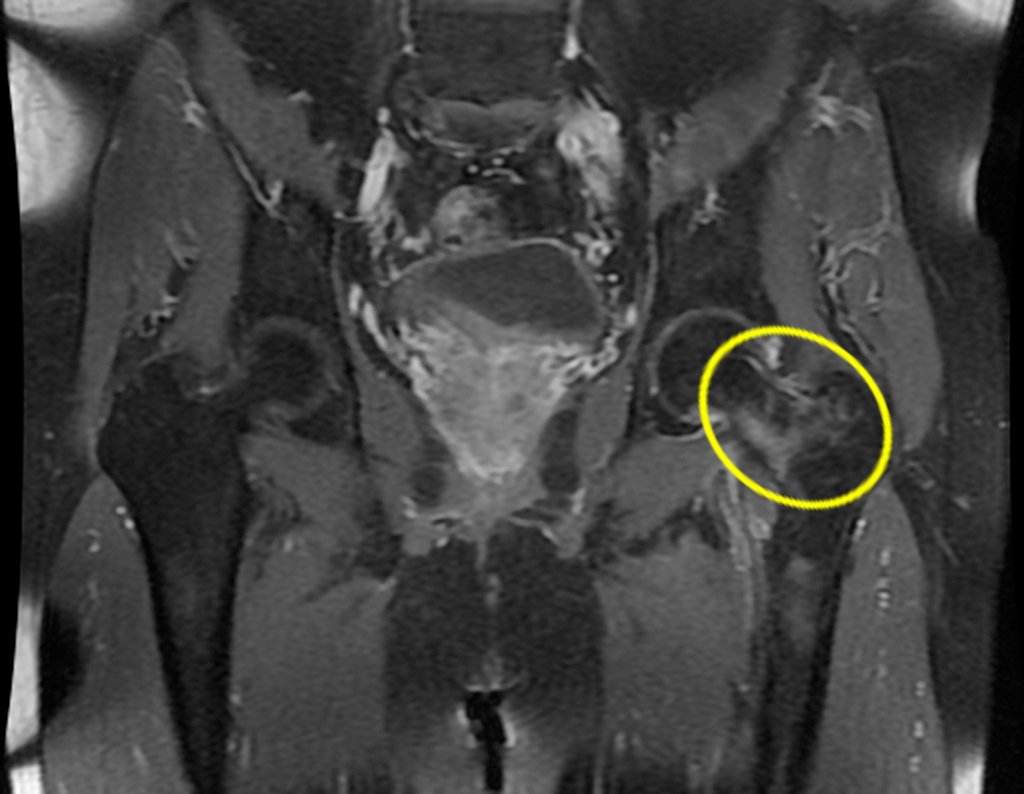 Figura 55: RM com evidente comprometimento mecânico do colo femoral, por forças de stress em flexão, propiciando a ocorrência de fratura.