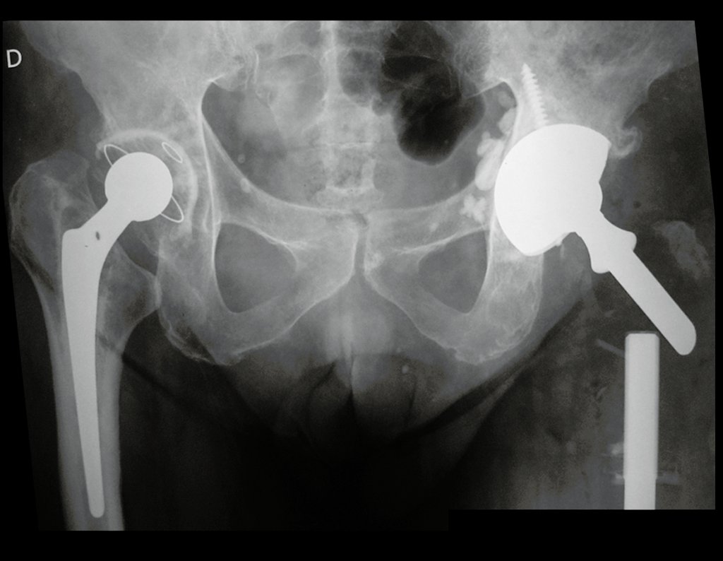 Figura 61: Radiografia da bacia de 14/05/2014, após um mês da ressecção em bloco e reconstrução com endoprótese não convencional modular de polietileno e titânio.