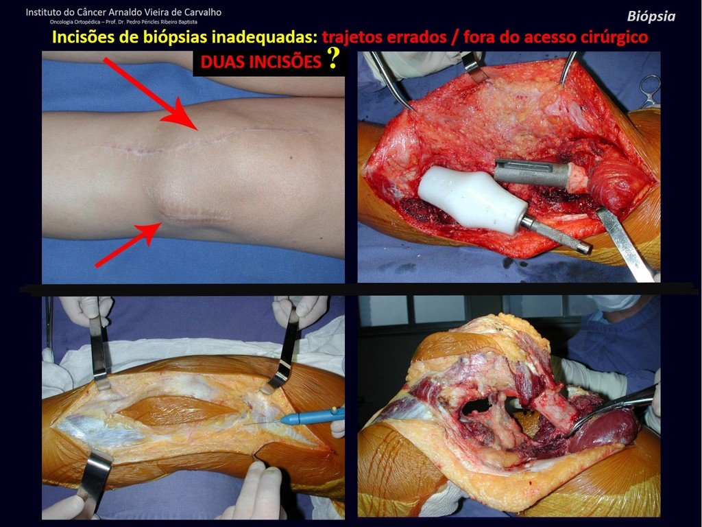 Figura 81: Duas incisões!!! Trajetos inadequados dificultando a ressecção com margem do condrossarcoma. Foi necessária uma ressecção extra articular e reconstrução com uma artrodese empregando-se uma prótese rígida de joelho, feita sob medida.