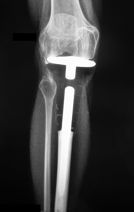 Figura 121: Radiografia, frente, com três anos da cirurgia.