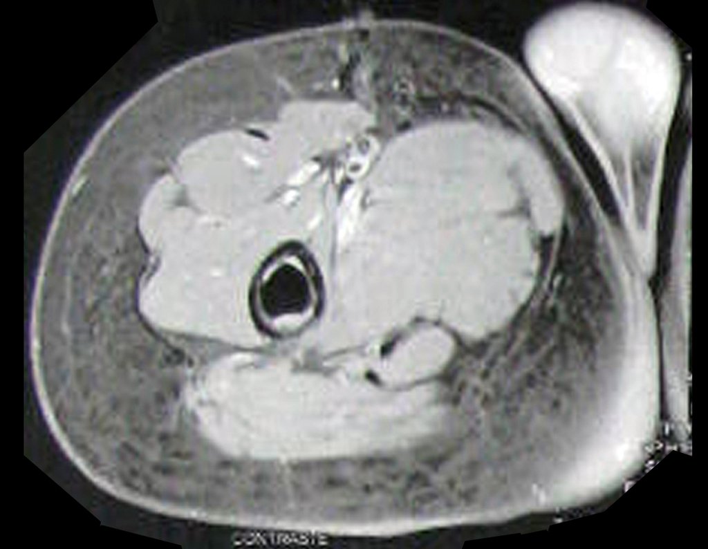 Figura 125: RM ax T1 fat, a imagem de baixo sinal na medular óssea corresponde a haste da prótese, circundada por halo de alto sinal que corresponde ao cimento ósseo.