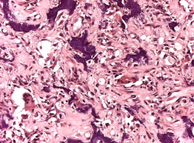 Figura 22: Histologia, osteossarcoma osteoblástico.