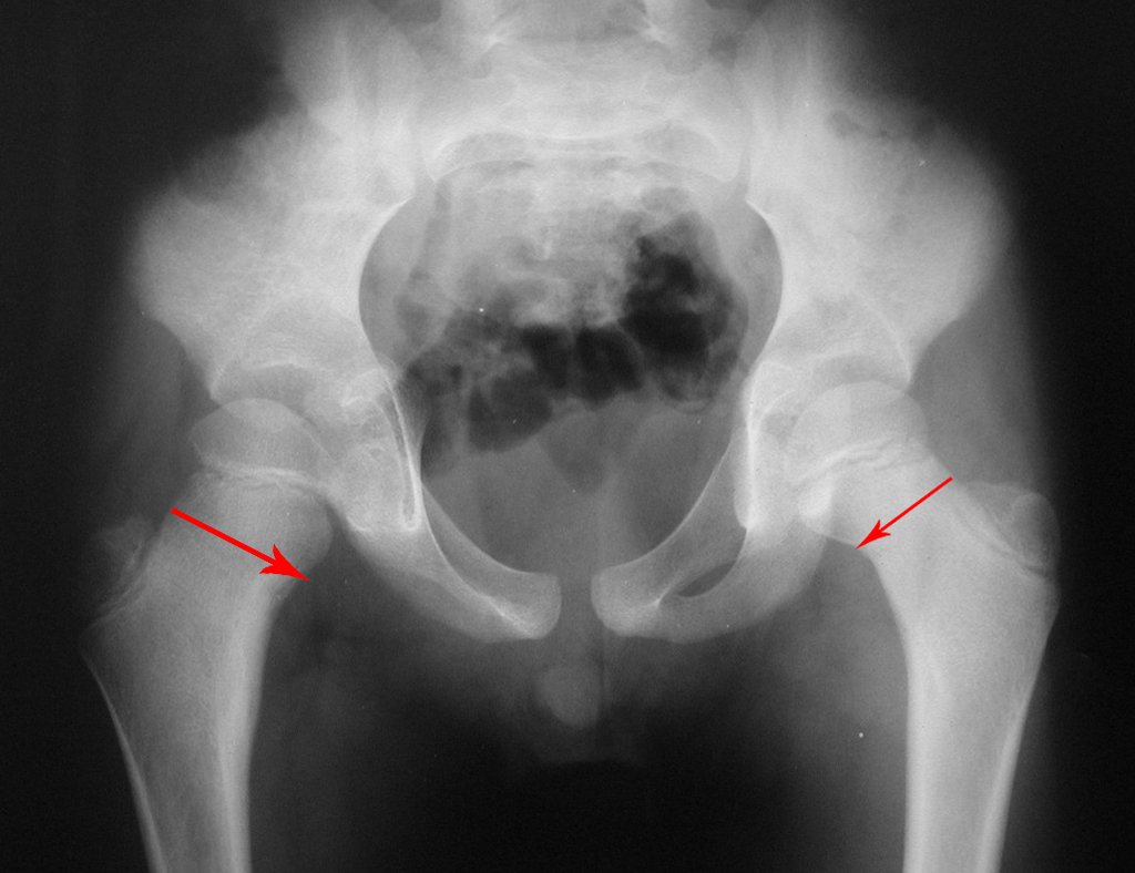 Figura 3: Radiografia da bacia, quadris de frente, com a imagem da lesão na cortical medial. As setas salientam o alargamento do colo femoral à direita.