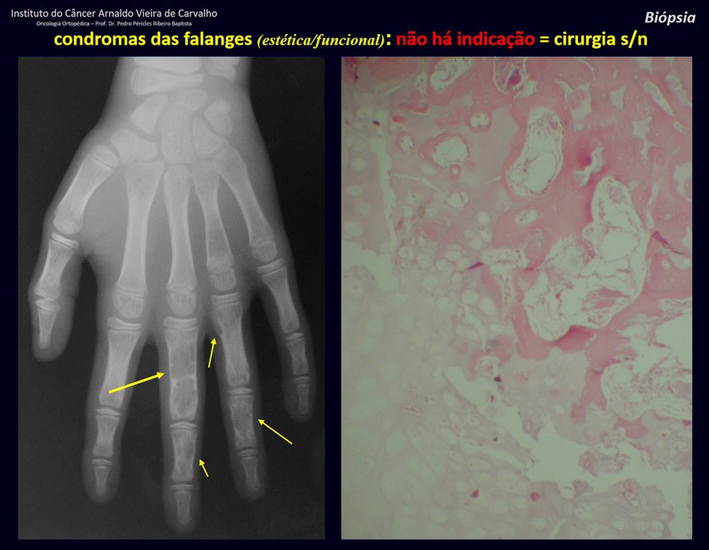 Figura 33: Condromas das falanges, achado casual. Histologia de condroma, cartilagem madura.