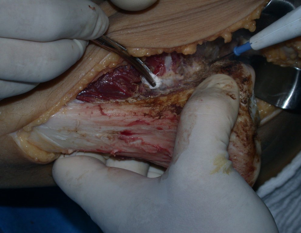 Figura 46: Liberação da sindesmose tíbio-fibular proximal e do ligamento colateral lateral.