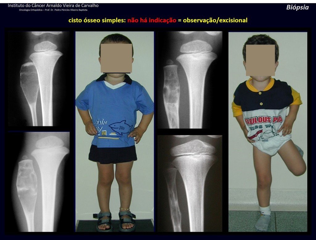 Figura 56: Cisto ósseo simples na fíbula. Esta é a única localização que pode eventualmente ser mais largo do que a metáfise, devido à cortical fina poder insuflar-se. A fíbula não é osso de carga, podemos observar. Com o crescimento afasta-se da linha epifisial e mineraliza, evoluindo para cura.