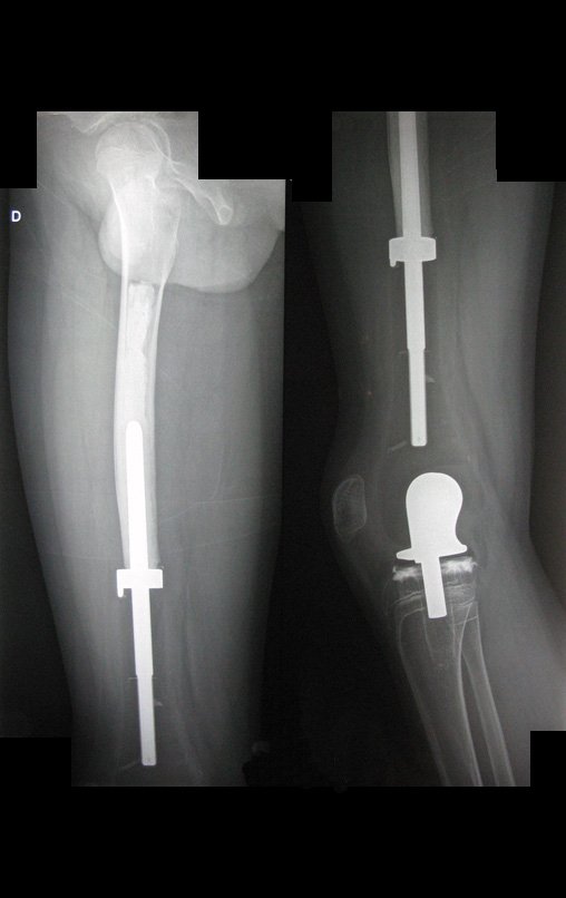 Figura 131: Radiografias em perfil, evidenciando o correto posicionamento da prótese.