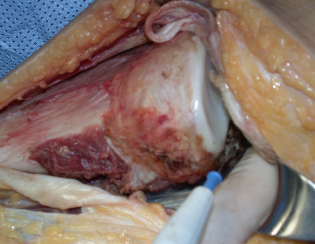 Figura 44: Liberação da cápsula posterior e ligamentos cruzados.