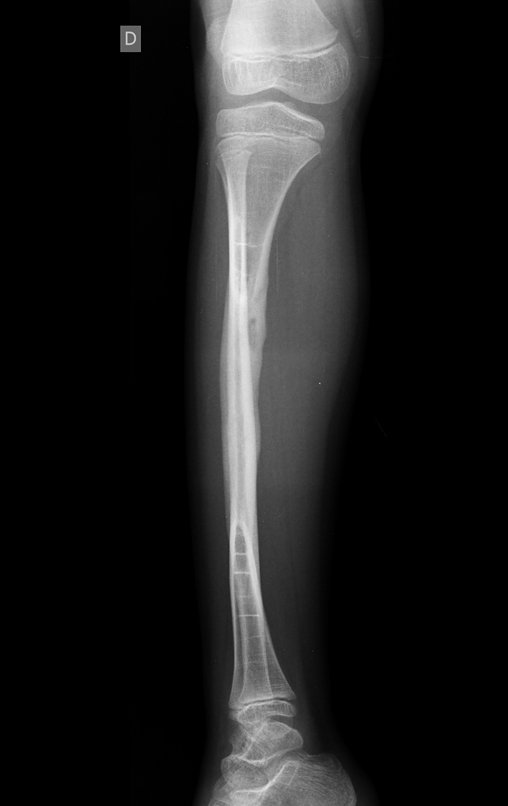 Figura 154: Radiografia ampliada da reconstrução com auto enxerto de fíbula e enxerto homólogo, em 10/11/2015.