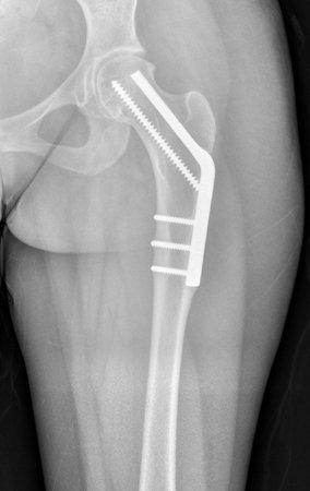 Figura 99: Radiografia de quadril operado, após doze anos. Boa congruência articular.