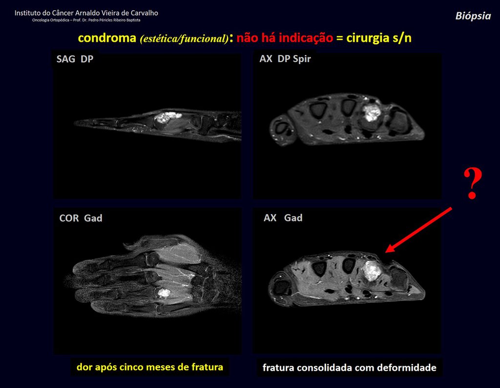 Figura 36: Cortical com insuflação fina causando dor. Captação de gadolínio. OPERAR?