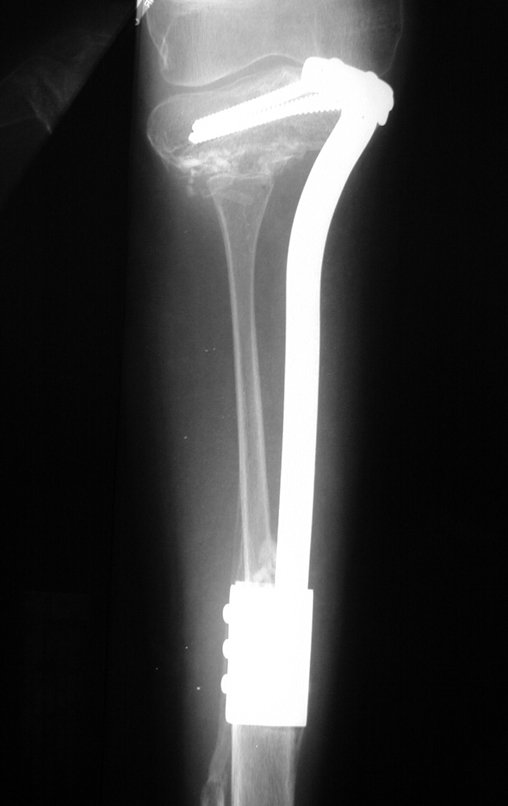 Figura 77: Radiografia de 01/03/2000, após cinco meses da cirurgia, com valgismo.