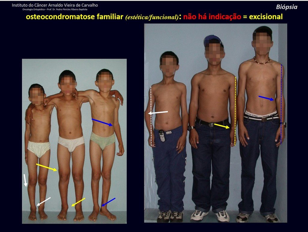 Figura 29: Osteocondromatose múltipla hereditária. Lesões múltiplas em irmãos, setas brancas, amarelas e azuis. Deformidade angular e encurtamento do membro superior.