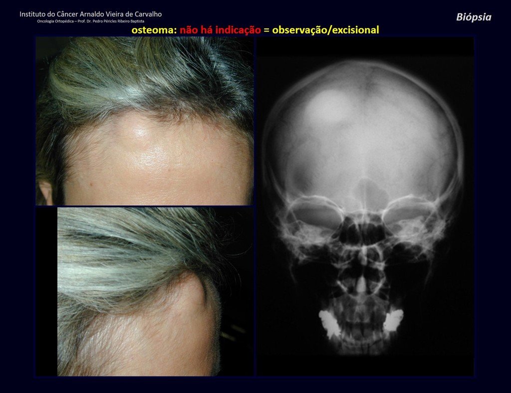 Figura 13: Paciente com 43 anos de idade, apresentando tumor no crâneo havia oito anos, indolor, que dificultava para pentear o cabelo. Radiografia com lesão esclerótica homogenia.