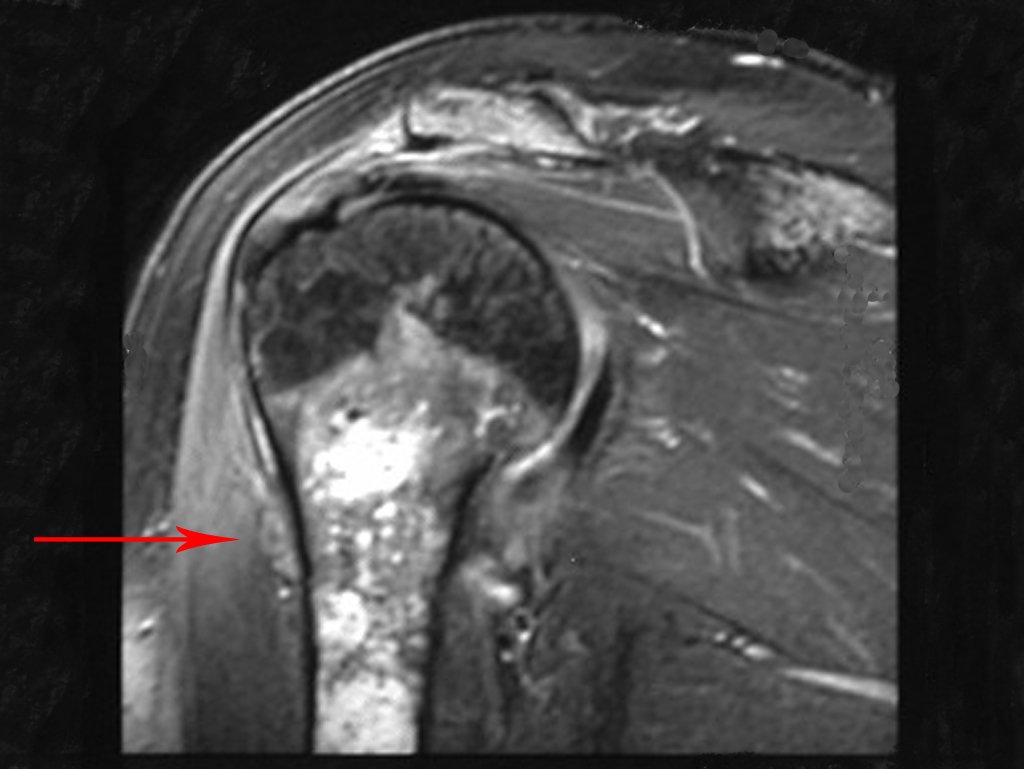 Figura 8.C: Rm cor T2, com supressão de gordura evidencia tumor extra cortical, contaminando o espaço sub-periósteo.