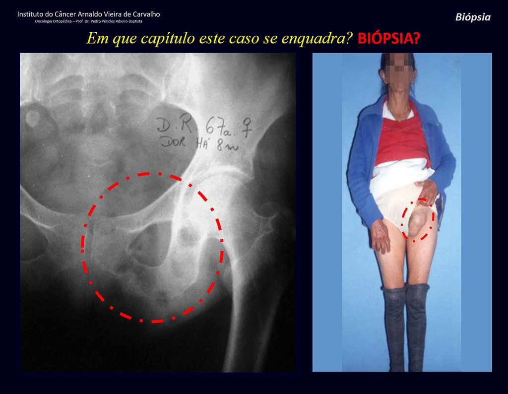 Figura 5: Radiografia da pelve esquerda com lesões de rarefação no ramo ílio-isquiático, paciente mostrando a lesão, destacada em vermelho.