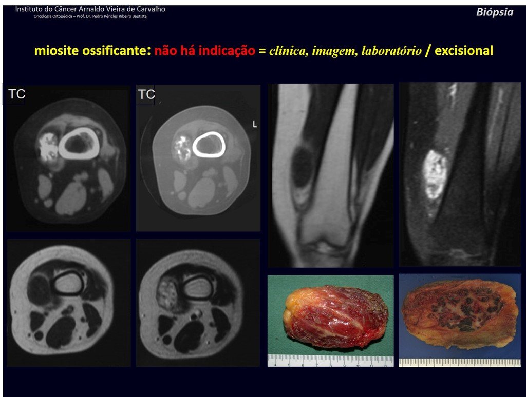 Figura 72: Tomografia e ressonância evidenciando ossificação em tecidos moles, principalmente na periferia da lesão. A biópsia pode dar falso diagnóstico de osteossarcoma!