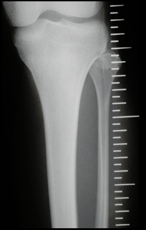 Figura 15: Radiografia, com régua, da fíbula que será utilizada na reconstrução do punho.