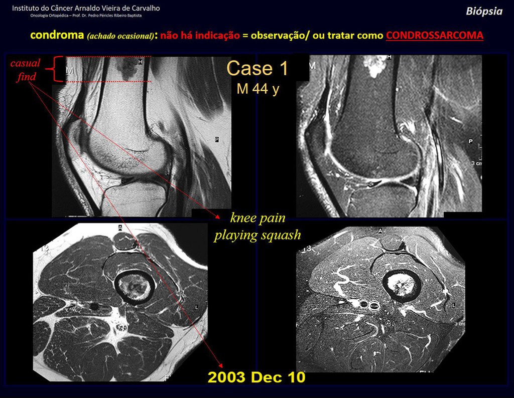 Figura 39: Paciente com dor na interlinha do joelho após esporte. Ressonância para estudo da articulação mostra achado casual de lesão na metáfise distal do fêmur. CONDROMA / CONDROSSARCOMA GRAU I? QUAL A MELHOR CONDUTA?