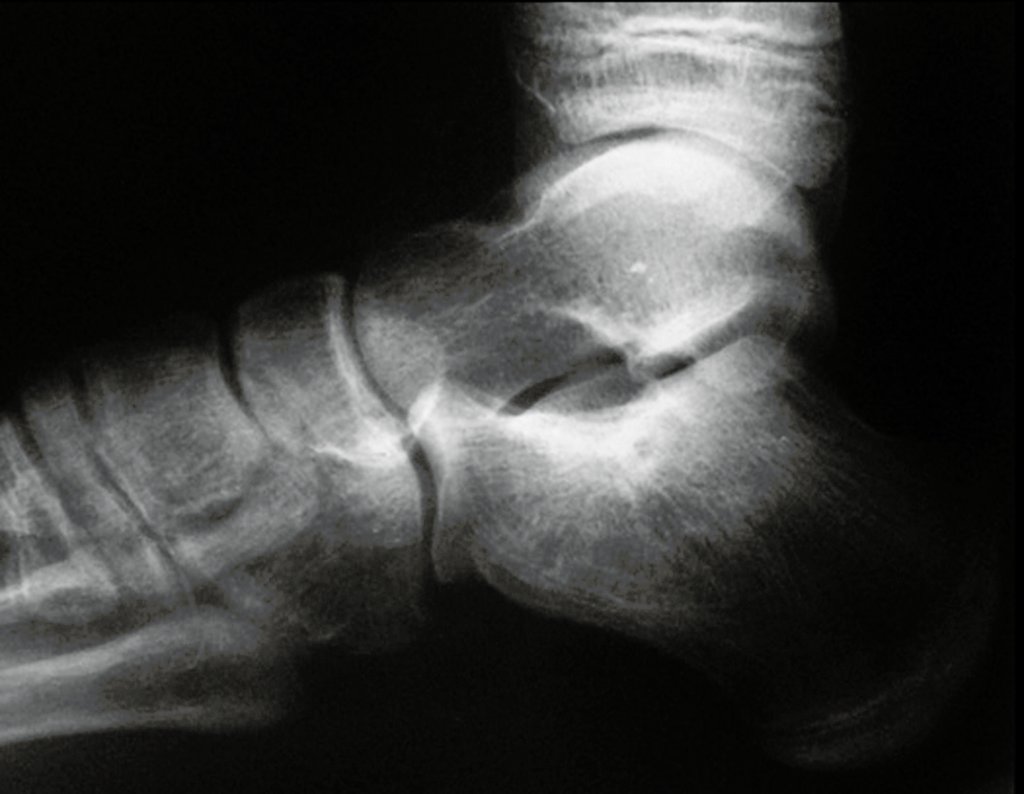 Figura 3: A radiografia do tornozelo em perfil, com penetração adequada, evidencia a esclerose e destaca um nicho central.