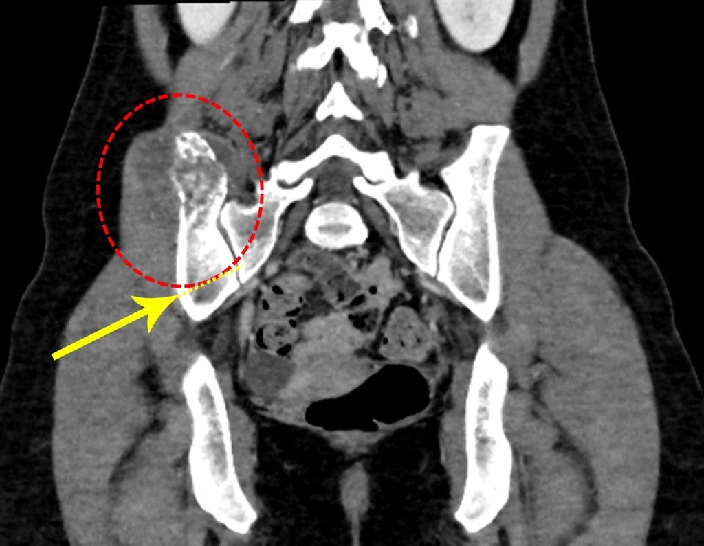 Figura 90: Tomografia coronal. Observamos a lesão na crista ilíaca, círculo vermelho e a região póstero inferior sem lesão, podendo-se preservar uma ponte sacro ilíaca, seta amarela.