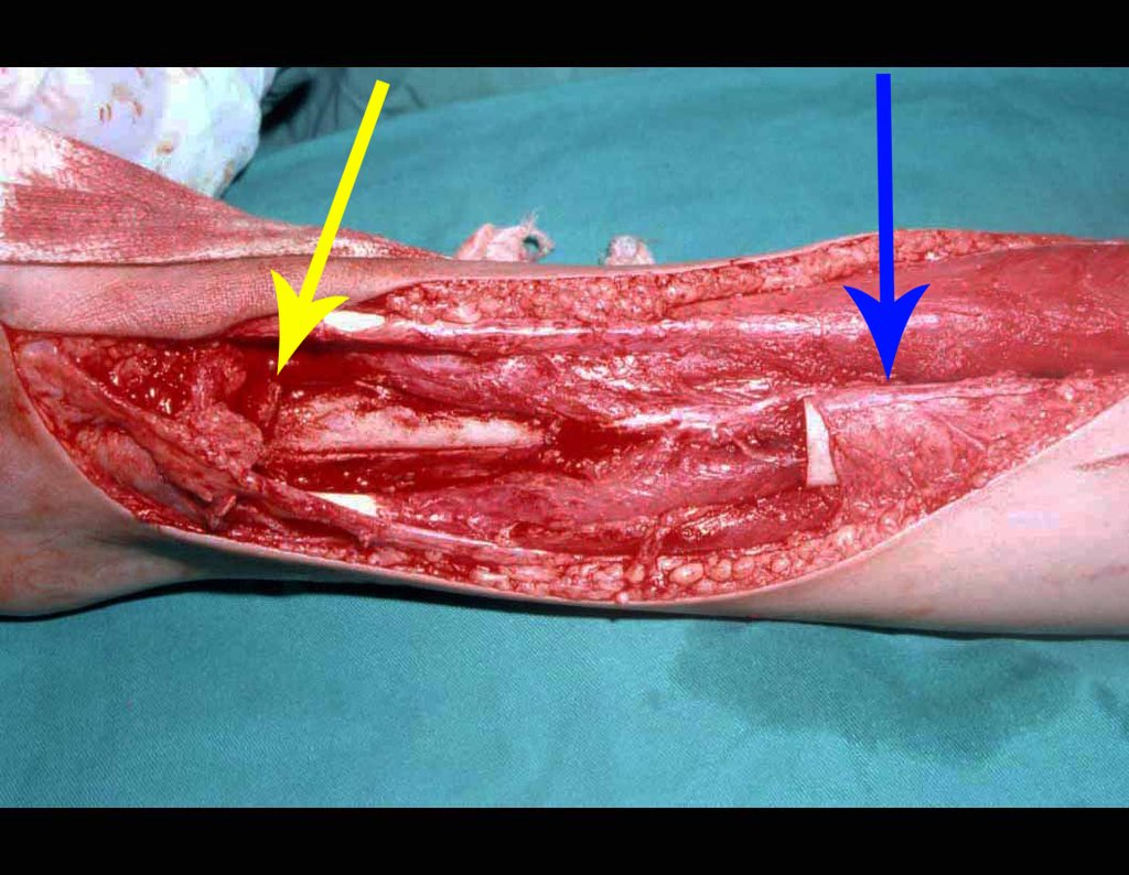 Figura 14: Colocação da epífise fibular na cavidade do tálus, seta amarela e posicionamento proximal da diáfise fibular no 1/3 proximal da tíbia, seta azul.