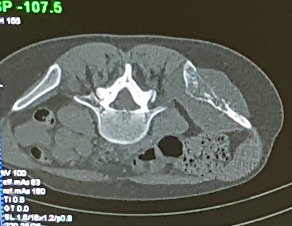 Figura 94: Controle tomográfico da lesão, com o paciente em decúbito prono.