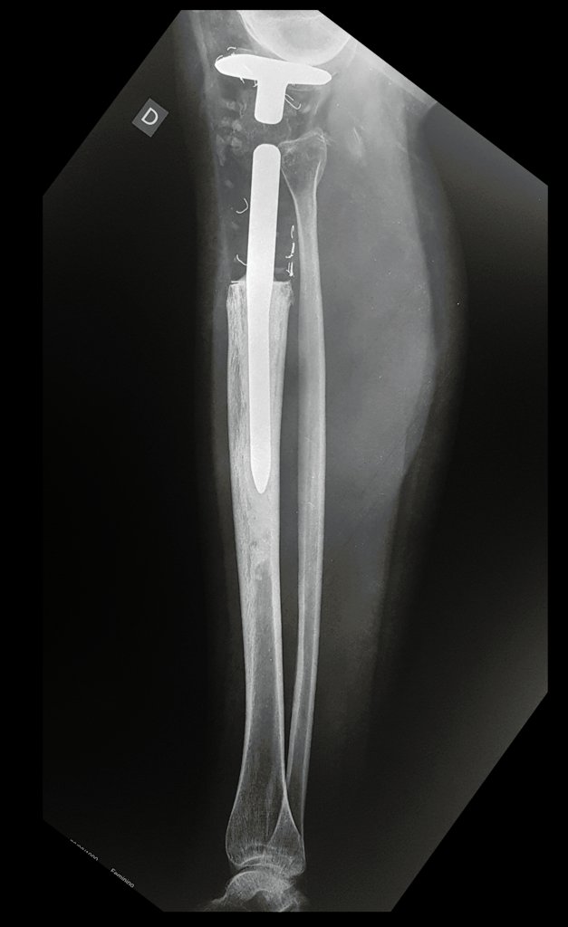 Figura 169: Radiografia, perfil, em 08/08/2017. Pós-operatório de doze anos.