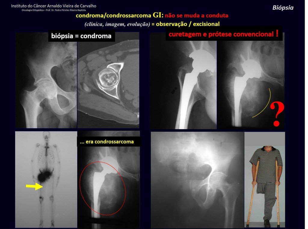 Figura 45: Lesão cartilaginosa, focos de calcificação e erosão da cortical, em cuja amostra de biópsia ¨diagnosticou¨ CONDROMA. Operado com prótese convencional, sem ressecção com margem. Em pouco tempo houve evolução do tumor, CONDROSSARCOMA, levando a uma necessidade de hemipelvectomia, cirurgia ablativa.