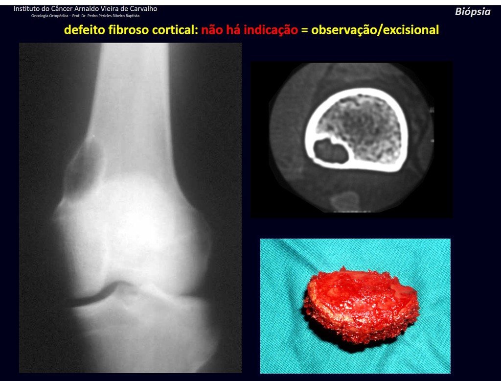 Figura 63: Radiografia com lesão circunscrita na cortical do fêmur. Na tomografia observamos que é homogênea, pequena, menor que 1.5 cm, delimitada por halo de esclerose. Defeito fibroso cortical operado por desconforto leve, devido à inserção do músculo adutor.