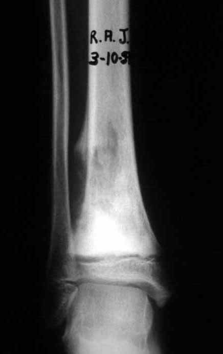 Figura 3: Radiografia frente de osteossarcoma do tornozelo direito, em quimioterapia neo-adjuvante.