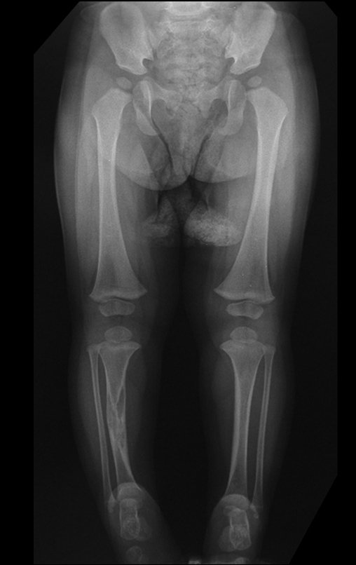 Figura 16: Radiografia de MMII com lesão apenas na tíbia direita, 17/04/2008.