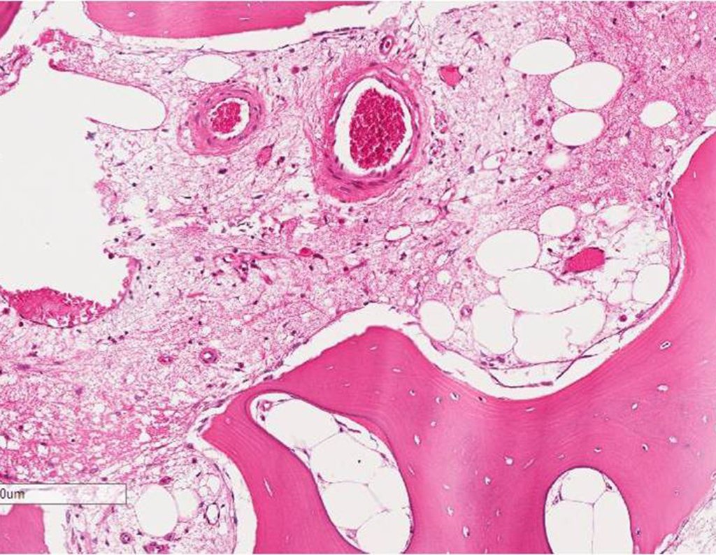 Figura 113: Fibrose e inflamação.