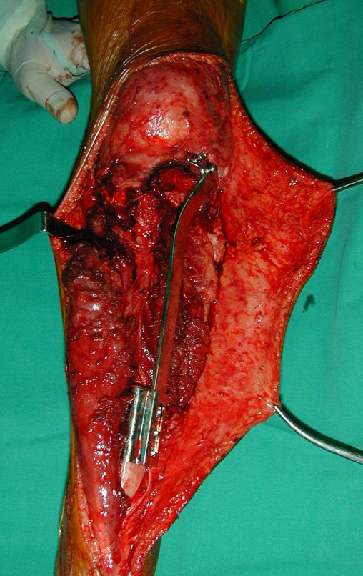 Figura 46: Osteossíntese terminada, estabilizando a reconstrução do autotransplante da fíbula, com a sua cartilagem de crescimento, para a tíbia.