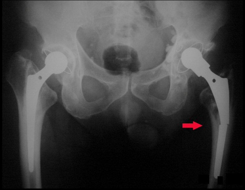 Figura 3: Soltura do componente femoral e quebra da haste à esquerda, fevereiro de 2008.