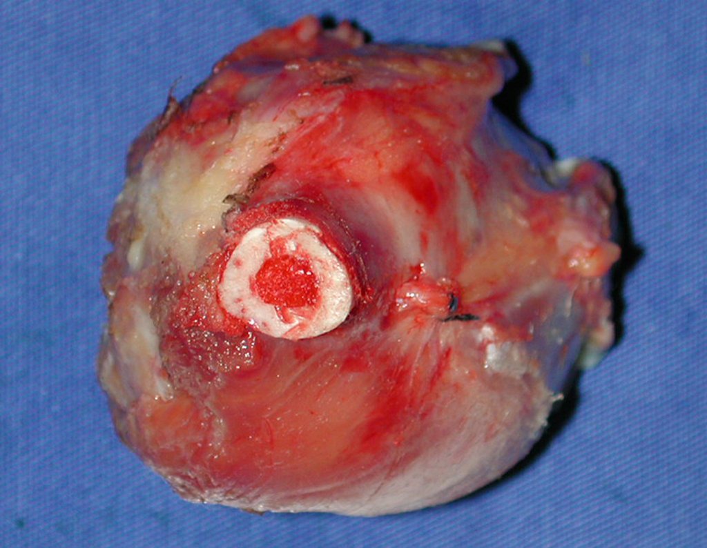 Figura 53: Face da osteotomia evidência macroscopicamente a ressecção com margem oncológica circunferencialmente.