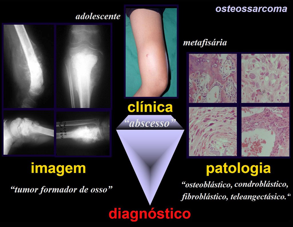 EXEMPLO 1: Lesão de limites imprecisos, agressiva, heterogênea, produtora de tecido ósseo, na região metafisária dos ossos longos em adolescente é a identidade do OSTEOSSARCOMA.