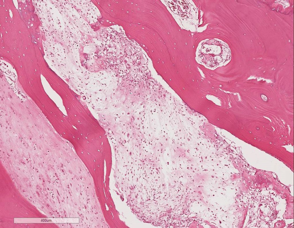 Figura 111: Erosão óssea por neoplasia cartilaginosa.