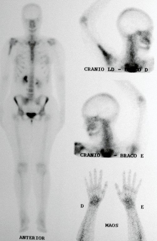 Figura 6.B: Cintilografia evidenciando hiper-captação na região proximal do úmero direito.