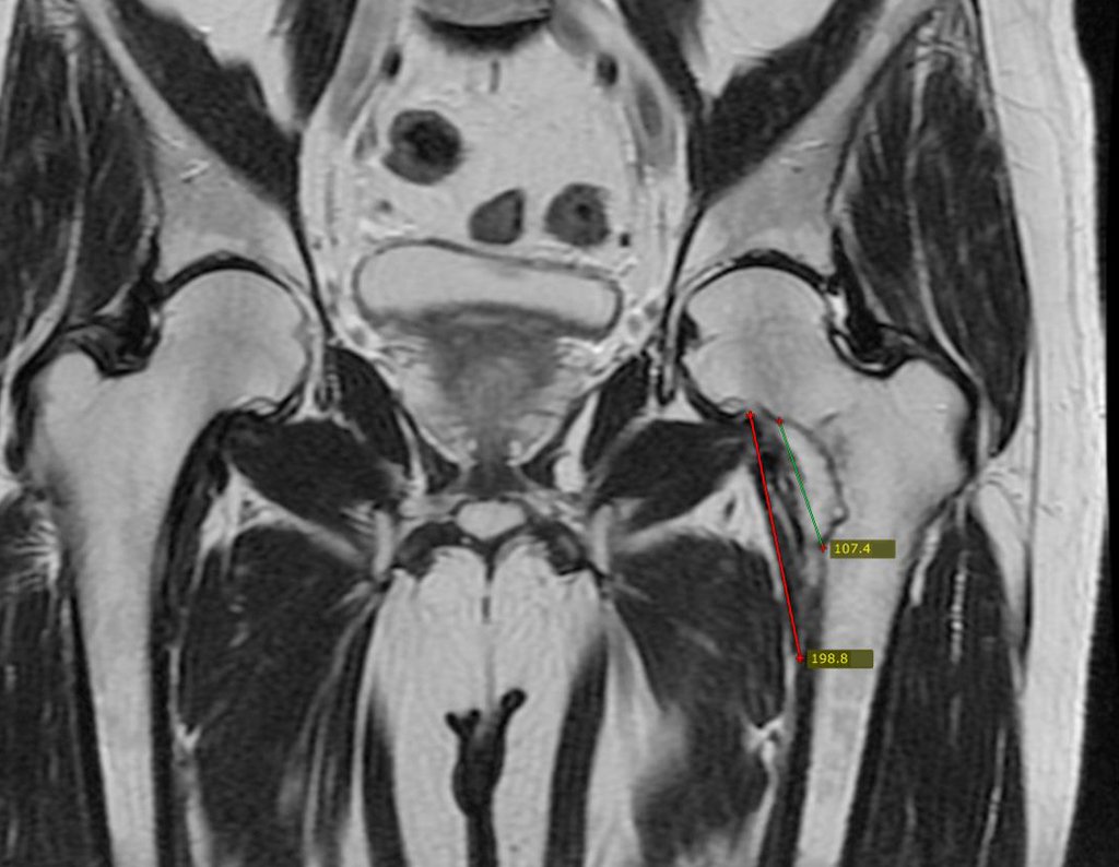 Figura 27: RM coronal t2, aumento da lesão na cortical do colo medial e na medular.