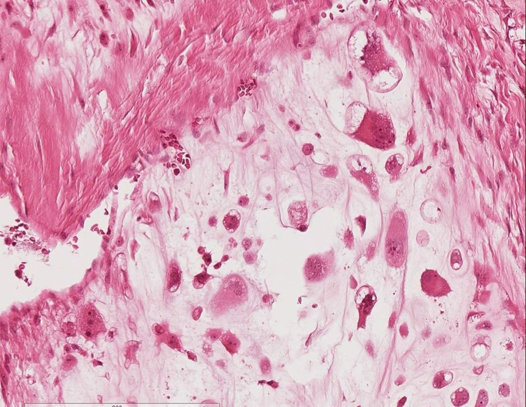 Figura 113: Neoplasia cartilaginosa, com polimorfismo celular.