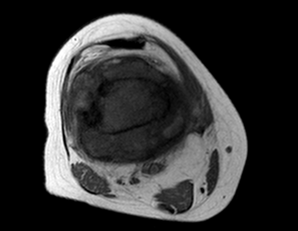 Figura 26: RM axial T1, pós quimioterapia de indução, mostrando condensação da lesão, que traduz boa resposta ao tratamento.