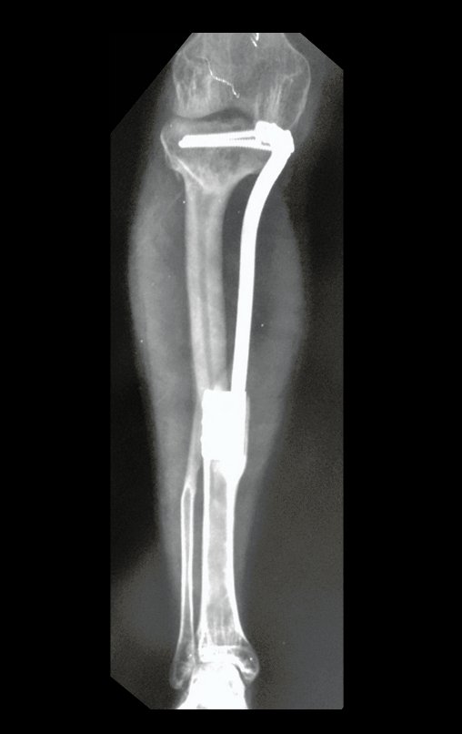 Figura 159: Radiografia de 15/11/2015, após 16 anos, com excelente hipertrofia da fíbula e bom alinhamento do membro operado.