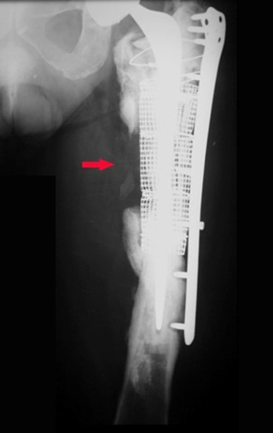 Figura 12: Calo reativo, pela movimentação do conjunto. Soltura da placa e infecção, com fístula produtiva. Realizada nova limpeza cirúrgica, outubro de 2013.