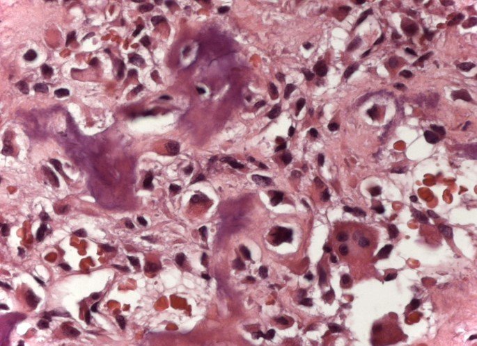 Figura 21: Histologia, osteossarcoma osteoblástico.