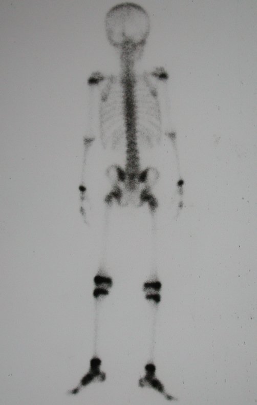 Figura 4: Radiografia da bacia em obturatriz, tumor obliterando o forame.