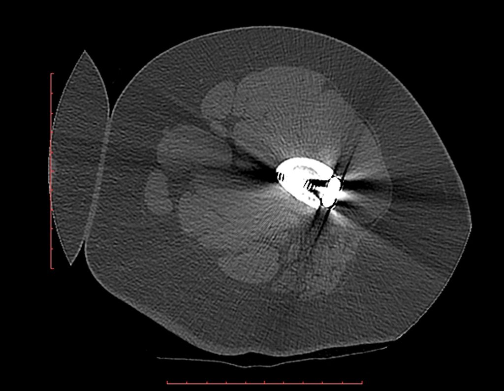 Figura 104: Tomografia do final, há haste da placa, na diáfise femoral, em março de 2016.