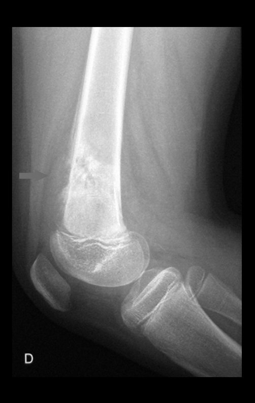 Figura 2: Na radiografia em perfil, observa-se a área de condensação irregular, e a expansão tumoral extracortical na face anterior. Triangulo de Codman e reação periosteal lamelar fina.