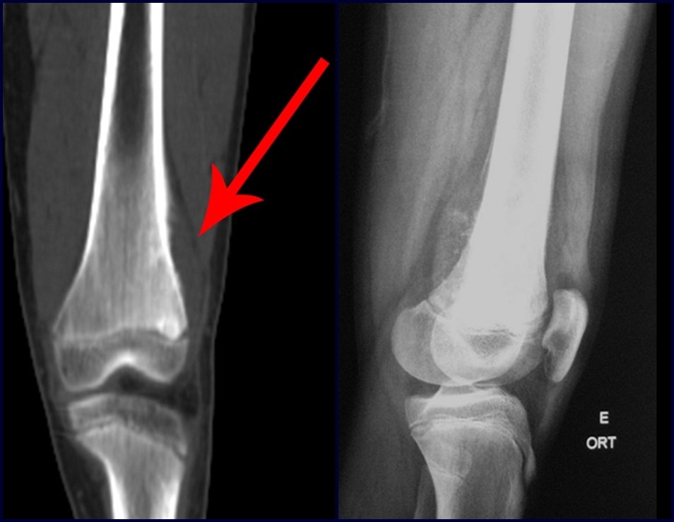 Figura 115: Radiografia de frente com lesão na face lateral da metáfise distal do fêmur esquerdo, seta em vermelho e face posterior, radiografia em perfil.