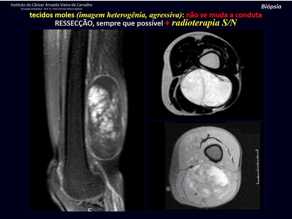 Figura 77: Tumor heterogêneo da região posterior da coxa, deslocando os vasos femorais e o nervo ciático. SARCOMA DE TECIDOS MOLES.